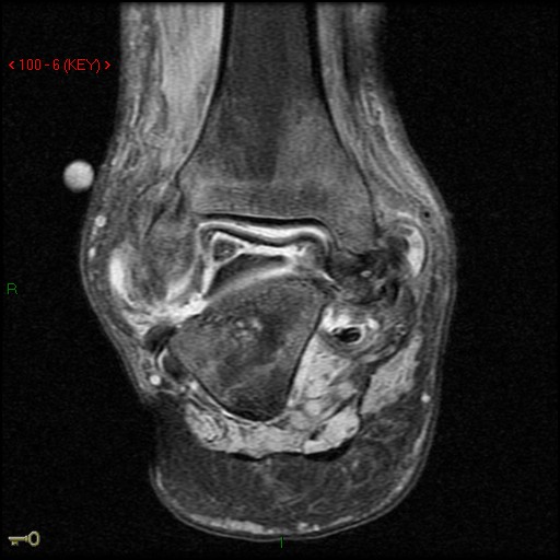 Figure 3 for case AVN talus